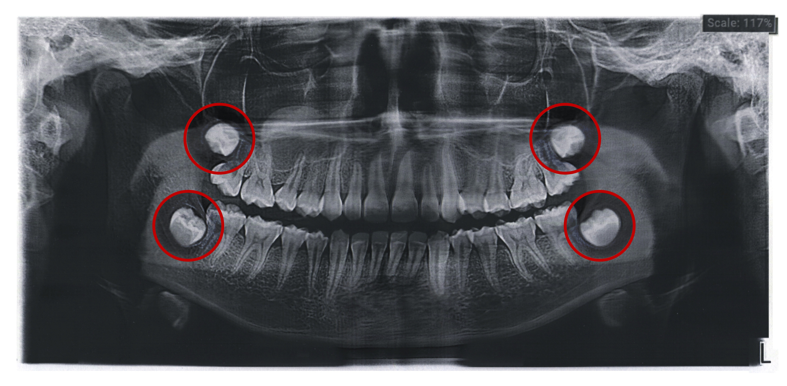 Radiografía de las muelas del juicio de un paciente joven en consultorio dental moderno.