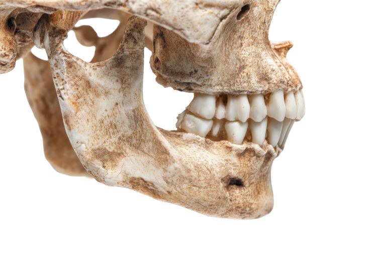 Lesión de mordedura humana con escala métrica utilizada en análisis de odontología forense.