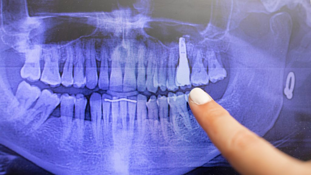 Identificación humana mediante implantes dentales en odontología forense